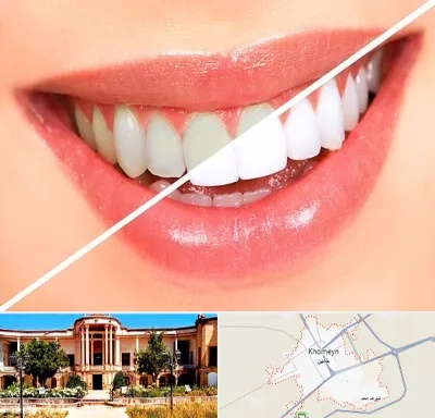 بلیچینگ دندان در خمین