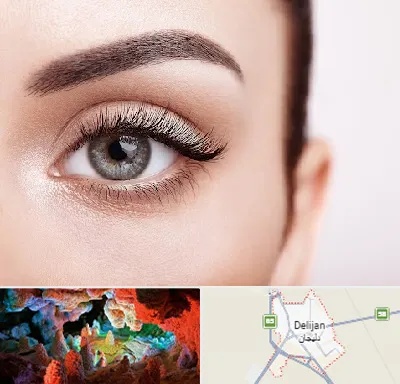 فوق تخصص عنبیه در دلیجان