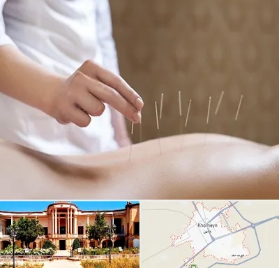 درای نیدلینگ در خمین