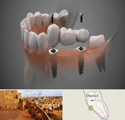 ایمپلنت دیجیتال در میبد