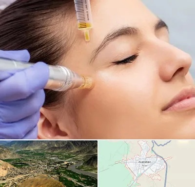میکرونیدلینگ در اسدآباد