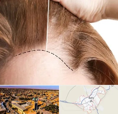 کاشت مو برای خانمها در بافق