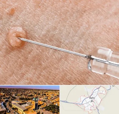 لیزر زگیل تناسلی در بافق
