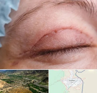 جراح پلک در اسدآباد