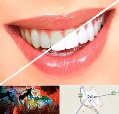 بلیچینگ دندان در دلیجان