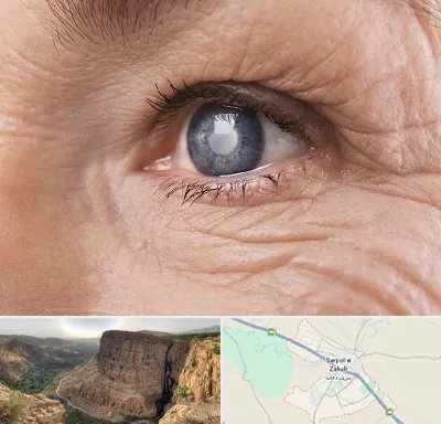 متخصص آب مروارید در سرپل ذهاب