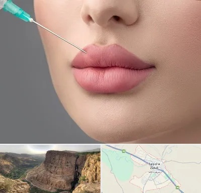 کلینیک ژل لب روسی در سرپل ذهاب