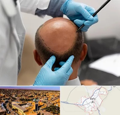 آموزش کاشت مو در بافق