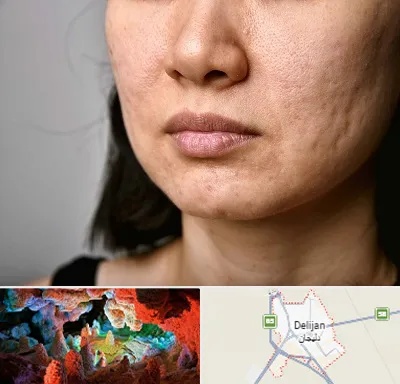 سابسیژن جای جوش در دلیجان