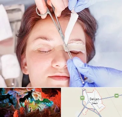 جراحی پلک افتاده در دلیجان