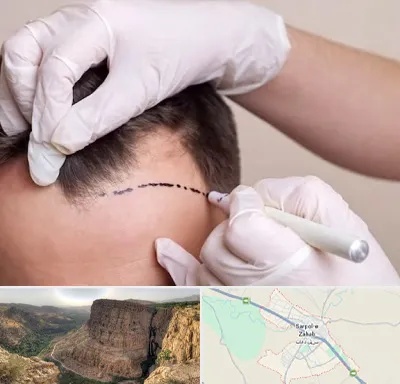 کاشت مو به روش SUT در سرپل ذهاب