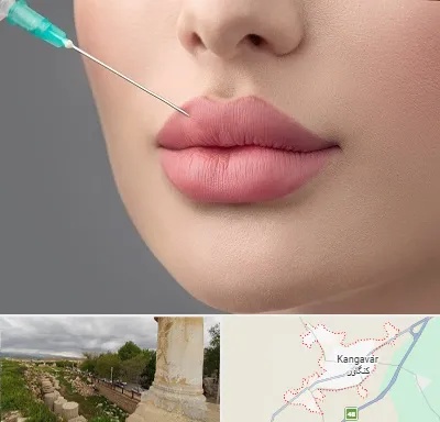 کلینیک ژل لب روسی در کنگاور