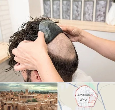 پروتز مو در اردکان