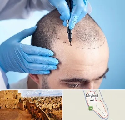 دکتر کاشت مو در میبد