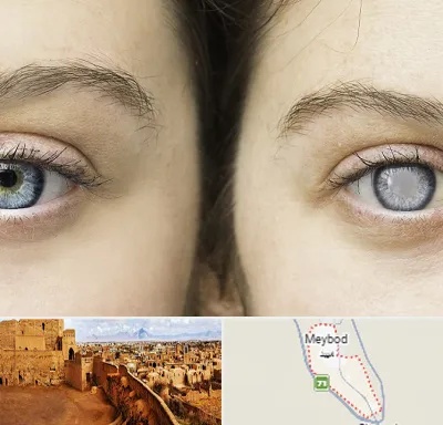 متخصص آب سیاه (گلوکوم) در میبد