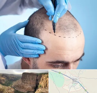 دکتر کاشت مو در سرپل ذهاب