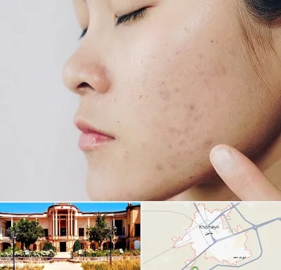 دکتر جوش صورت در خمین