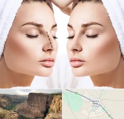 عمل بینی در سرپل ذهاب