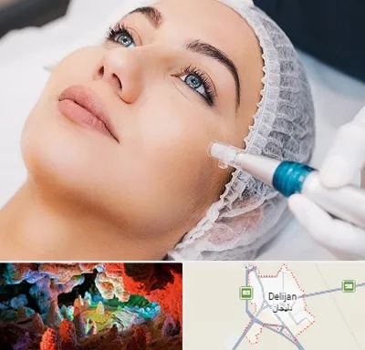 مزونیدلینگ در دلیجان