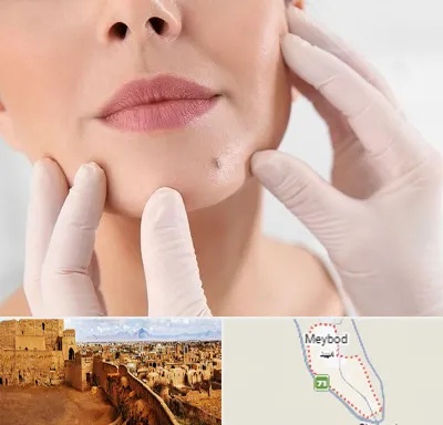 برداشتن خال در میبد