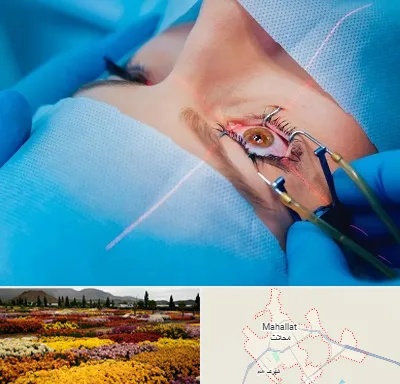 عمل prk چشم در محلات