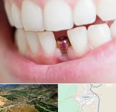 ایمپلنت اقساطی در اسدآباد