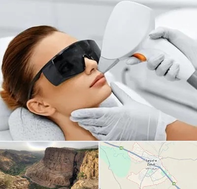 مرکز لیزر مو در سرپل ذهاب
