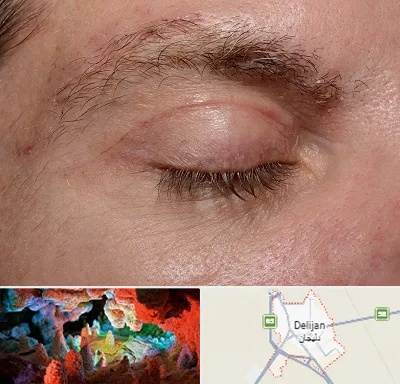 جراح بلفاروپلاستی در دلیجان