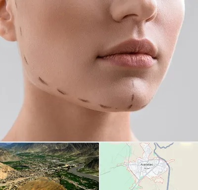 عمل زاویه فک در اسدآباد