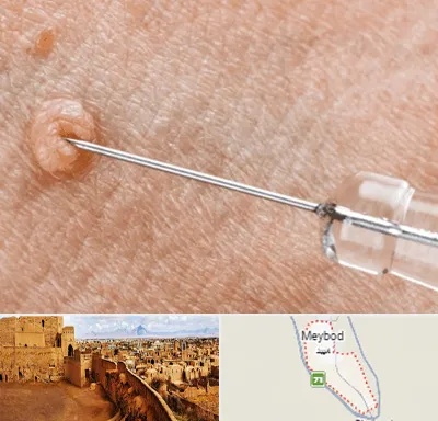 لیزر زگیل تناسلی در میبد