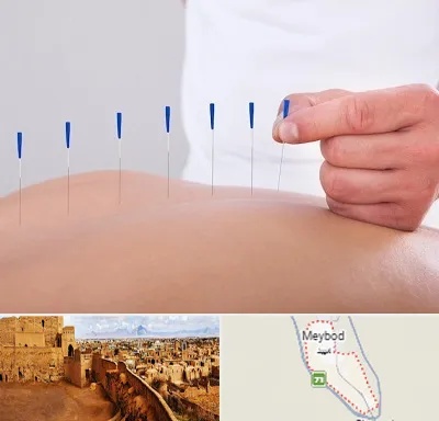 دکتر طب سوزنی در میبد