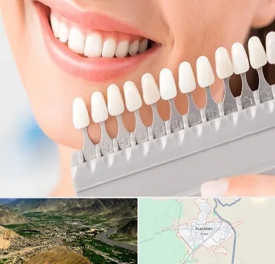 متخصص لمینت دندان در اسدآباد