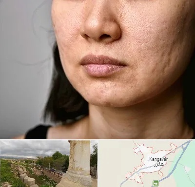 سابسیژن جای جوش در کنگاور