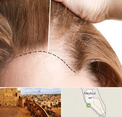 کاشت مو برای خانمها در میبد