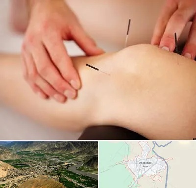 دکتر طب سوزنی برای لاغری در اسدآباد