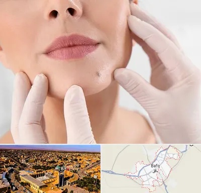 برداشتن خال در بافق