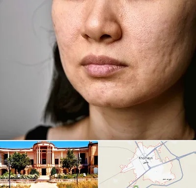 سابسیژن جای جوش در خمین
