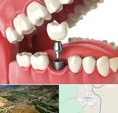 متخصص پروتز دندان در اسدآباد