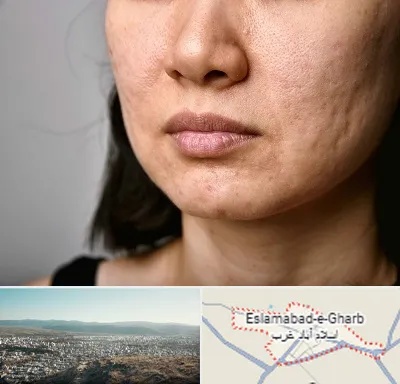 سابسیژن جای جوش در اسلام آباد غرب