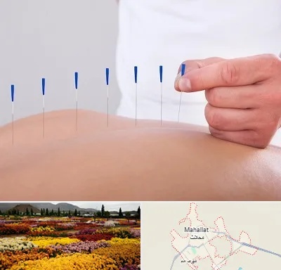 دکتر طب سوزنی در محلات