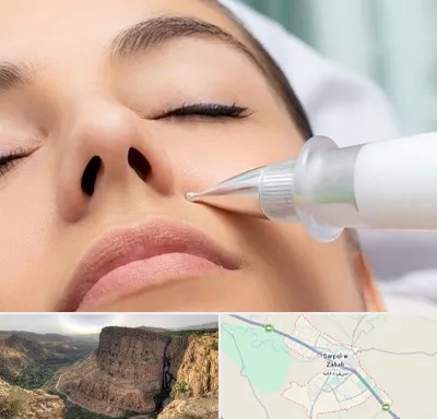 پلاسما جت بینی در سرپل ذهاب