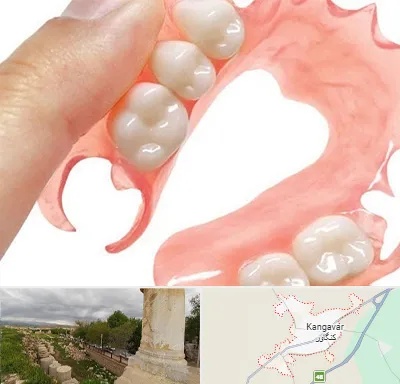 پروتز متحرک دندان در کنگاور