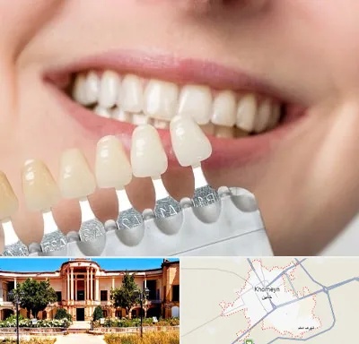 مرکز کامپوزیت دندان در خمین