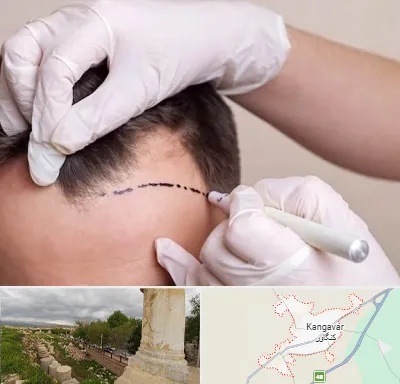 کاشت مو به روش SUT در کنگاور