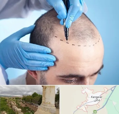 دکتر کاشت مو در کنگاور