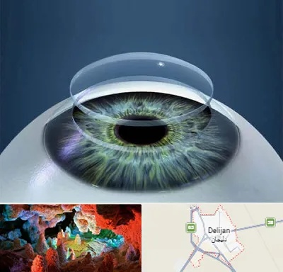پیوند قرنیه در دلیجان