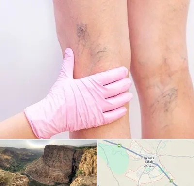 دکتر فوق تخصص واریس در سرپل ذهاب