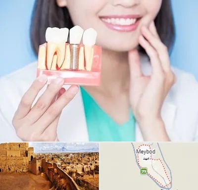 متخصص ایمپلنت در میبد