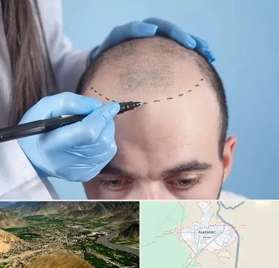 کاشت مو اقساطی در اسدآباد