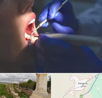عصب کشی در کنگاور
